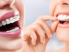 Diş Teli Yerine Şeffaf Plaklar Kayaşehir Dişçi - Başakşehir Dişçi - Şeffaf Plak Tedavisi