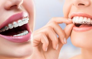 Kayaşehir Dişçi - Başakşehir Dişçi - Şeffaf Plak Tedavisi